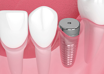 Illustration of dental implant in the jaw