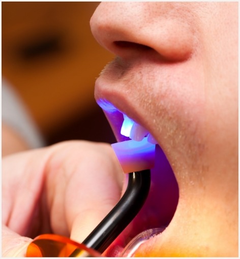 Close up of dental patient getting cosmetic bonding on a tooth