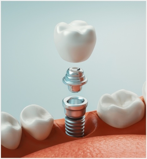 Illustration of dental implant and crown for lower arch