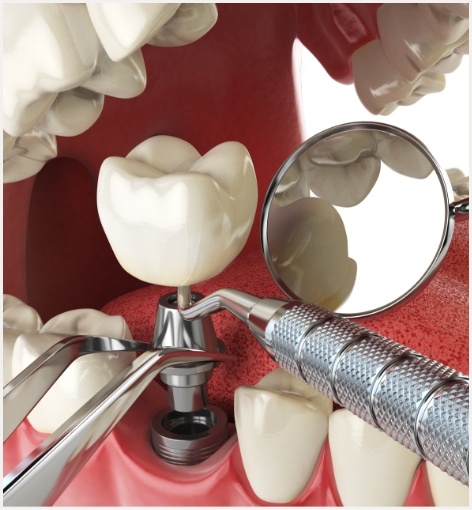 Illustrated dental implant being placed into the lower jaw