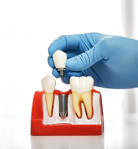 Dentist lifting a dental implant crown off a model implant post