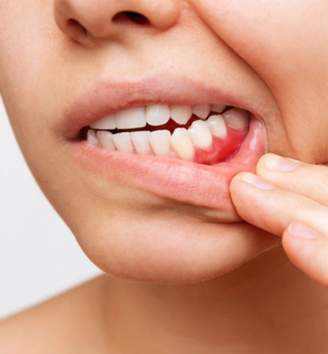 Woman pulling back her lip to reveal bleeding gums