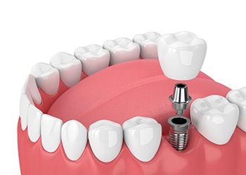 Illustration of dental implant