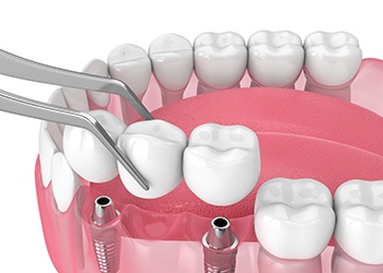 Illustration of implant bridge