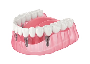 Illustration of implant denture