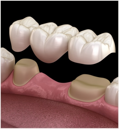 Illustrated dental bridge replacing a missing tooth