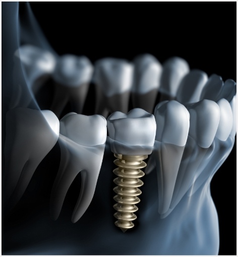 Illustrated x ray of a dental implant replacing a missing tooth