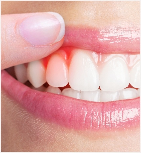 Close up of person pointing to red spot in their gums