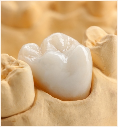 Dental crown over a tooth in a model of the mouth