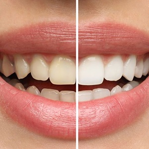 Woman’s smile before and after teeth whitening