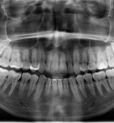 Dental X-ray showing four impacted wisdom teeth