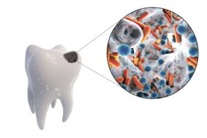 Molar damaged by tooth decay