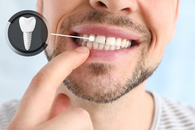 a man pointing at his dental implant restoration